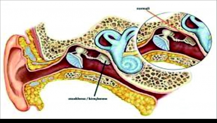 Orta kulak kireçlenmesi nedir?